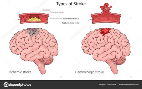 Xhamster Foto musik penyembuhan stroke informasi terbaru Sama halnya envelope snap panduan lengkap image 1